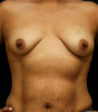 Breast Lift