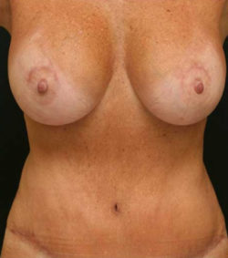 Breast Lift
