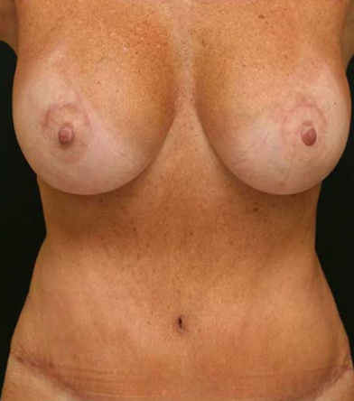 Breast Lift