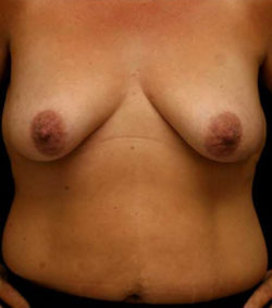Breast Lift