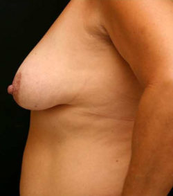 Breast Lift