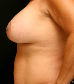 Breast Lift