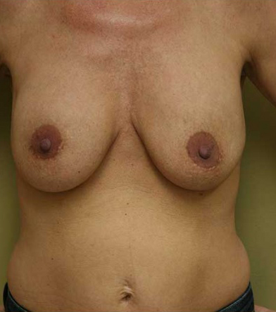 Breast Lift