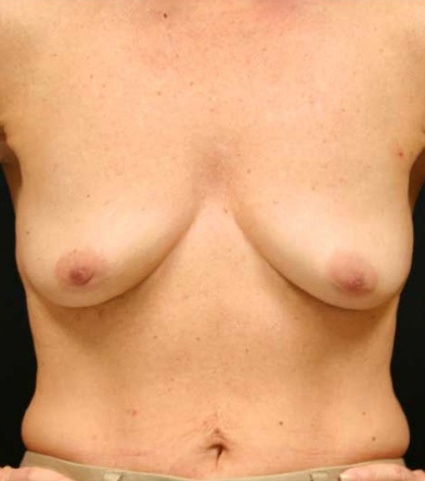 Breast Lift