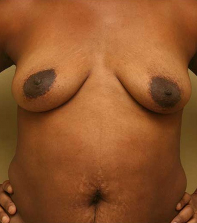Breast Lift