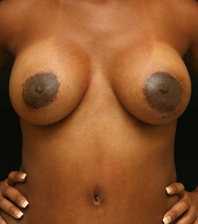 Breast Lift