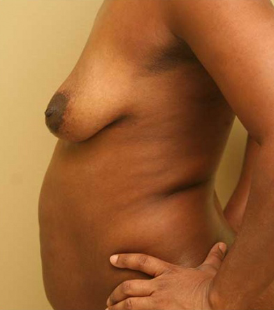 Breast Lift