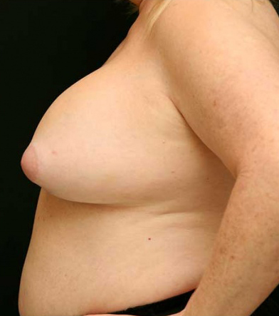 Breast Lift