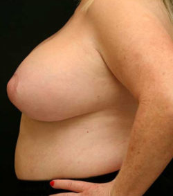 Breast Lift
