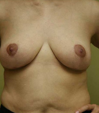 Breast Lift