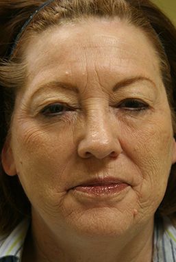 Facial Rejuvenation