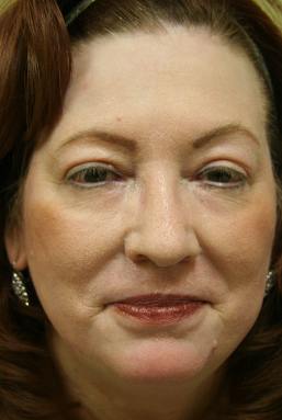 Facial Rejuvenation