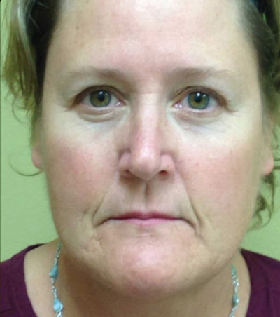 Facial Rejuvenation