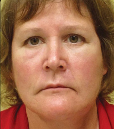 Facial Rejuvenation
