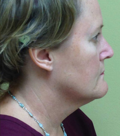 Facial Rejuvenation
