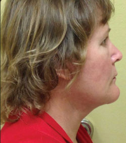 Facial Rejuvenation