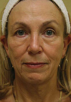 Facial Rejuvenation