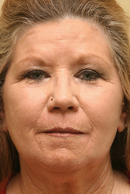 Facial Rejuvenation