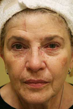Facial Rejuvenation