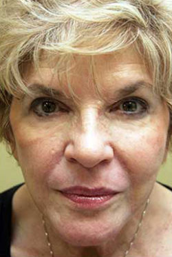 Facial Rejuvenation