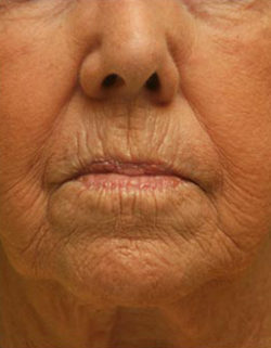 Facial Rejuvenation