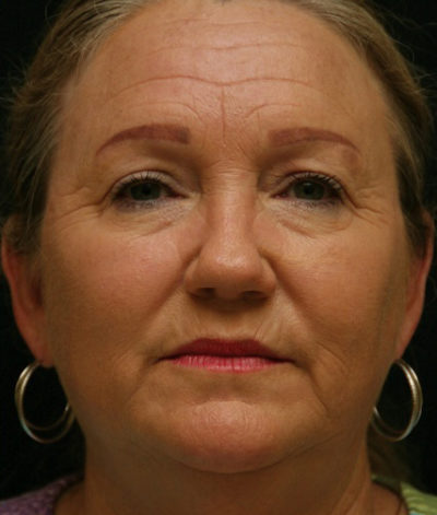 Facial Rejuvenation