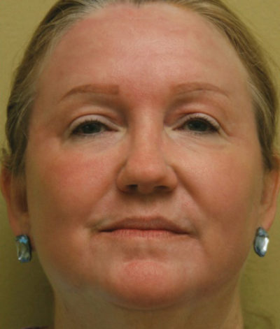 Facial Rejuvenation
