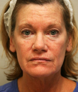 Facial Rejuvenation