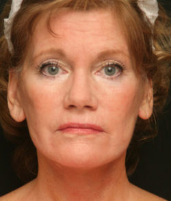 Facial Rejuvenation