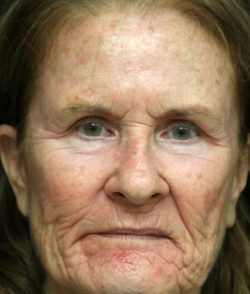 Facial Rejuvenation