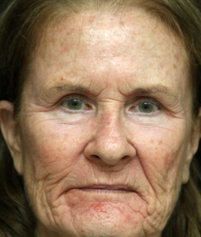 Facial Rejuvenation