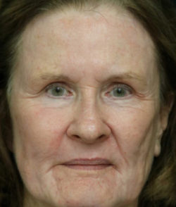 Facial Rejuvenation