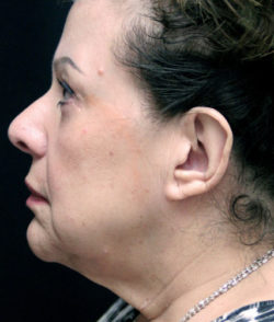 Facial Rejuvenation