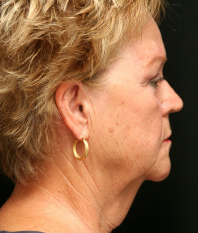 Facial Rejuvenation