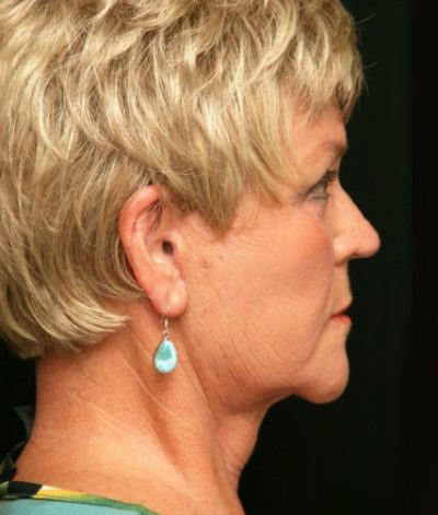 Facial Rejuvenation