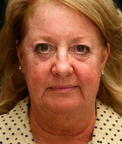 Facial Rejuvenation