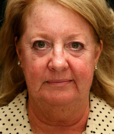 Facial Rejuvenation