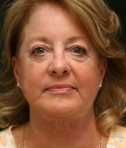 Facial Rejuvenation
