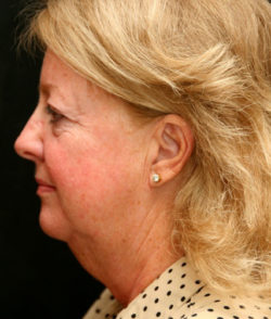 Facial Rejuvenation