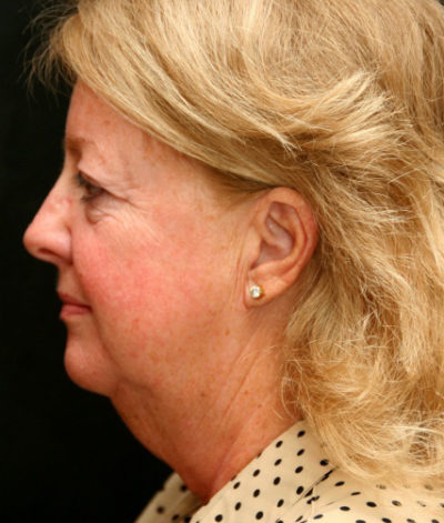 Facial Rejuvenation