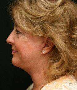 Facial Rejuvenation