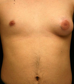 Gynecomastia