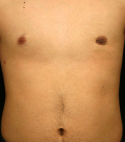 Gynecomastia