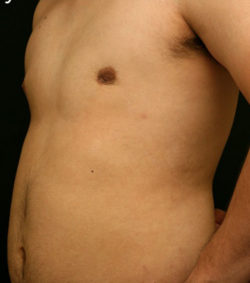 Gynecomastia