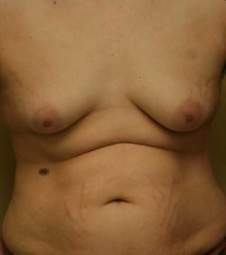 Gynecomastia