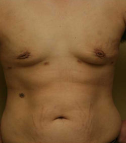 Gynecomastia