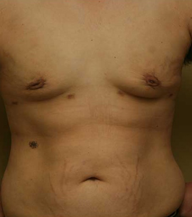 Gynecomastia