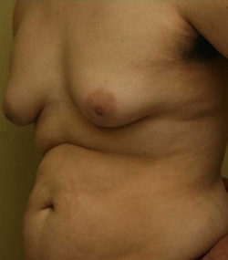 Gynecomastia