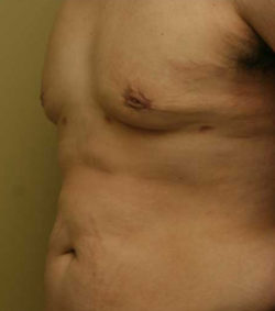 Gynecomastia