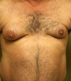 Gynecomastia